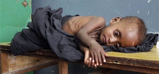 Podvyživené somálské dítě leží v nemocnici v metropoli Mogadišu. (8. července
