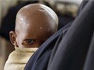 Somálské podvyivené dít v náruí své matky v nemocnici provozované