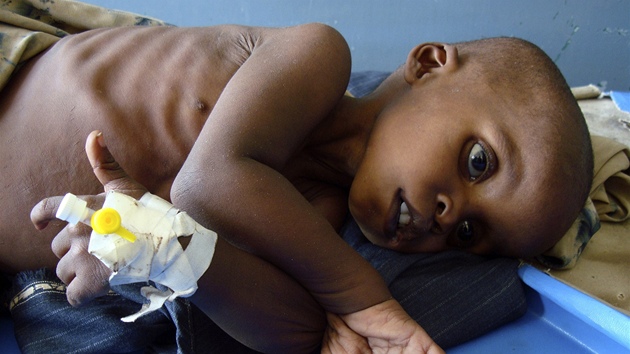 Tíletý Ismail Guleit leí v nemocnici v Mogadiu, dít je kvli suchu siln