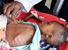Podvyživený tříletý Somálec Abdirisak Mursal leží v nemocnici v Mogadišu (16.