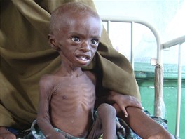Siln podvyiven tlet Abdihakin Omar v nemocnici Benadir v Mogadiu (21.