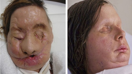 Charla Nashová ped (vlevo) a po transplantaci oblieje