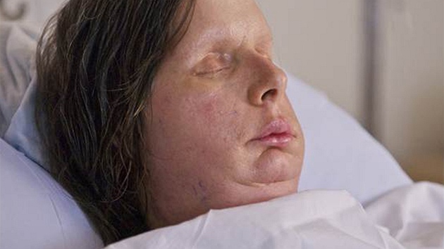 Charla Nashová po transplantaci oblieje (11. srpna 2011)