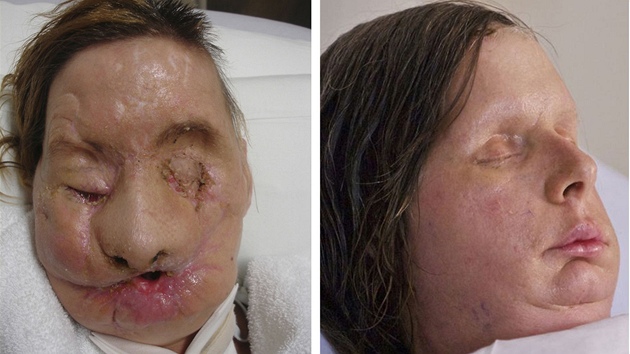 Charla Nashov ped (vlevo) a po transplantaci oblieje