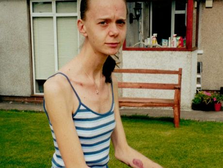 Alison Walkerov prola anorexi i bulimi