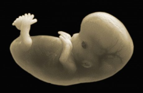Nejastjí píiny samovolných potrat jsou genetického pvodu (ilustraní snímek)