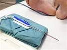  V pražském IKEM lékaři použili k operaci nádoru ojedinělý přístroj - nano nůž.
