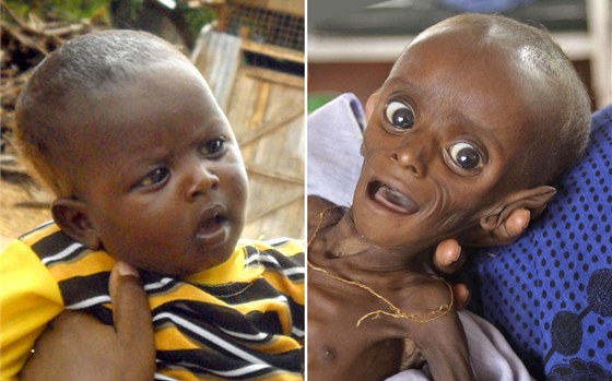 Malý Minhaj z Keni na snímku vlevo z íjna 2011 a vpravo o ti msíce díve.