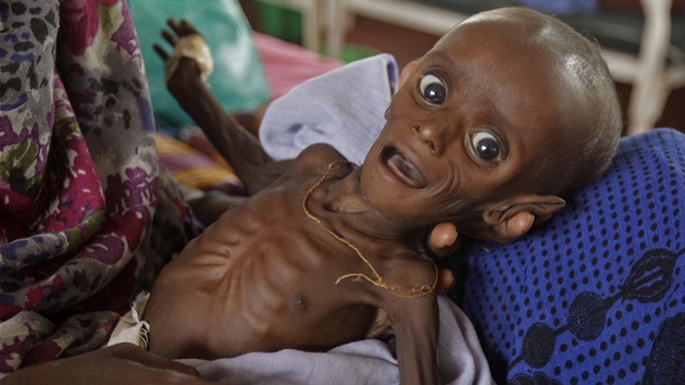 Vyzáblý sedmiměsíční Somálec Minhaj Gedi Farah krátce poté, co přišel do nemocnice v Keni (26. července 2011) 