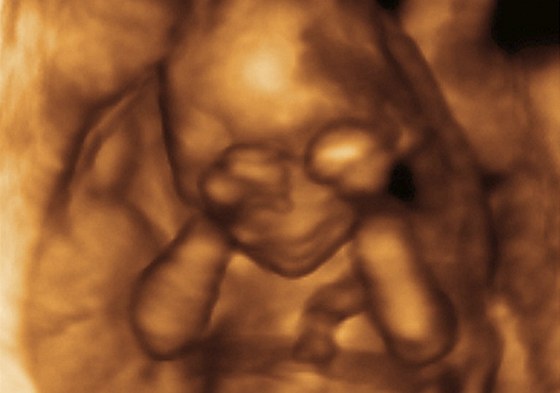 Na 3D ultrazvuku je dobe poznat, e se budoucí rodie mohou tit na chlapce. 