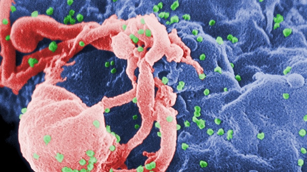 Snímek z elektronového mikroskopu zachycuje virus HIV (variantu HIV-1). Zelené body jsou viry, které se „líhnou“ z napadené imunitní buňky.