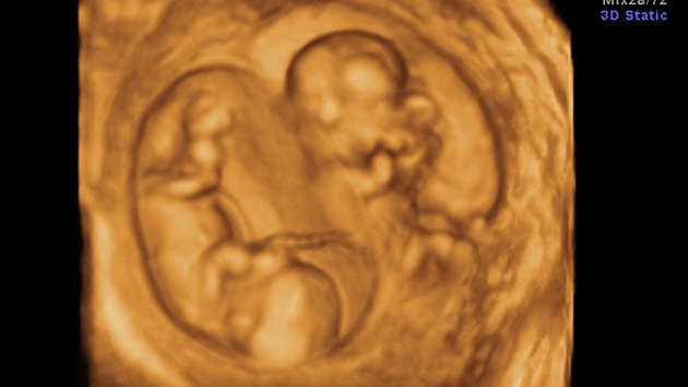 3D ultrazvuk, na kterém jsou vidt dvojata ve 12. týdnu thotenství.