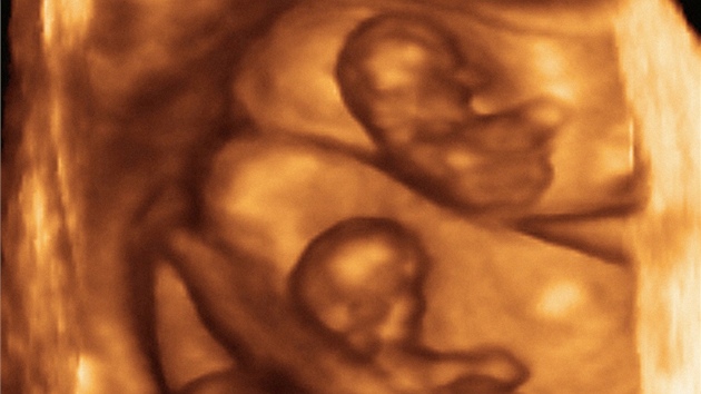 Nastvajc rodie se podle ultrazvuku mohou tit na trojata.