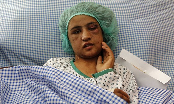 Afghánská dívka Sahar Gulová v nemocnici, kde skonila kvli tomu, e jí její