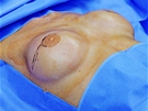 Výmna implantát PIP - pacientka tsn ped operací.