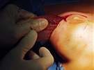 Výmna implantát PIP - vyjmutí implantátu s prmyslovým silikonem.