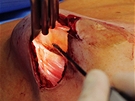 Výmna implantát PIP - oetení a kontrola dutiny po vyjmutí implantátu.