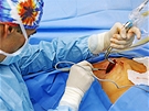 Výmna implantát PIP - oetení a kontrola dutiny po vyjmutí implantátu.