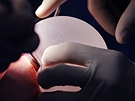 Výmna implantát PIP - vloení nového implantátu.