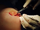 Výmna implantát PIP - ití po vloení nového implantátu.