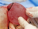 Výmna implantát PIP - vkládání bezpeného implantátu do tla pacientky.