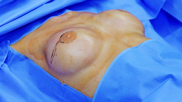 Vmna implantt PIP - pacientka tsn ped operac.