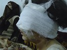 Holika zranná pi ostelování msta Homs (6. února 2012)