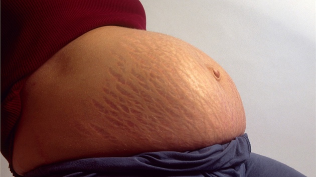 Velmi často se tvoří pajizévky v těhotenství, kdy se kůže na břiše prudce rozpíná. Tomu nelze nikterak předejít, záleží na kvalitě kůže.