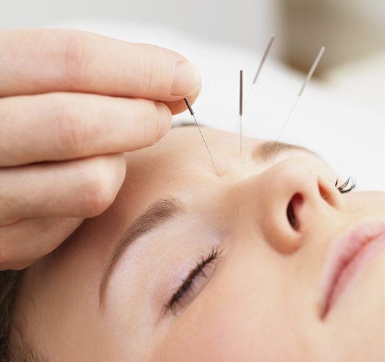Akupunktura pomáhá i pi bolestech hlavy.