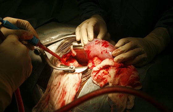 Transplantace ledviny (ilustrační snímek)