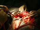 Transplantace ledviny (ilustraní snímek)