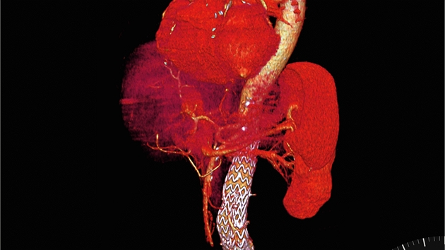 Srdce tídenního miminka s nadmrn nafouklou levou plící a aortou o pmru 1,9 milimetru