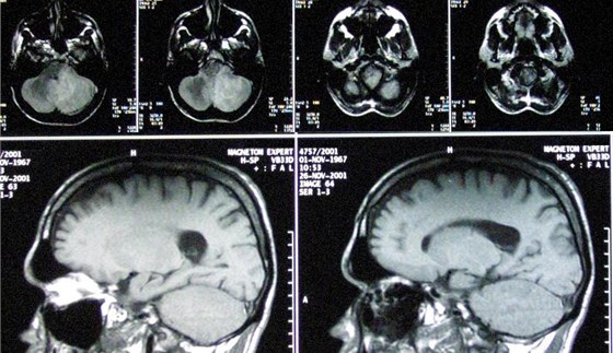 Olomoučtí vědci odhalili mechanismus, kterým se smrtelný zhoubný nádor mozku zvaný glioblastom brání léčbě. (Ilustrační snímek)