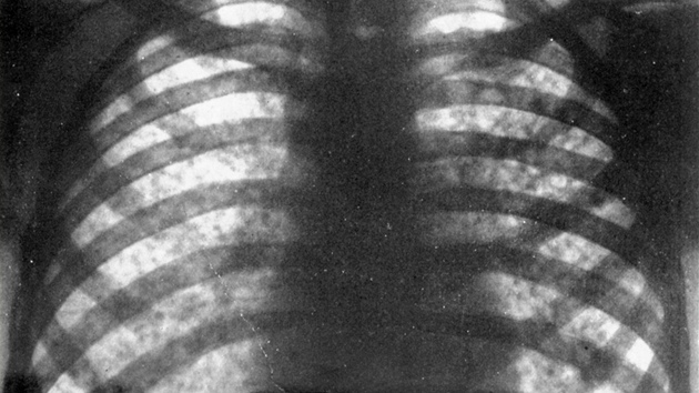 Tmavé skvrny na rentgenovém snímku plic jsou píznakem akutní plicní