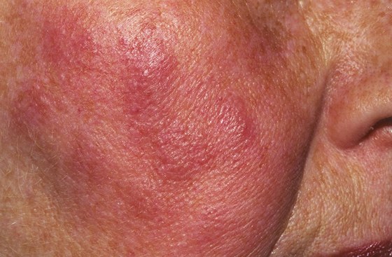 Kožní vyrážka u autoimunitního onemocnění lupus erythematosus. Ilustrační snímek