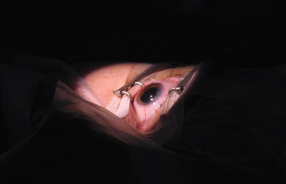 Nejdříve syn a pak i dcera podstoupili operaci obou očí (ilustrační snímek)