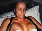 Lacey Wilddová po operaci v roce 2001