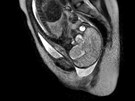 Snímek dítte v porodních cestách, který lékai získali pomocí magnetické
