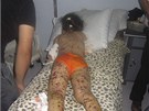 Syrská holika zranná pi ostelování Húlá (15. ervence 2012)