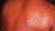 Syfilis provázejí kožní vyrážky