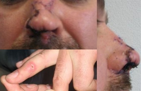 Pokousaný prst a nos mue, ktrého v Brn napadl opilý kamarád.