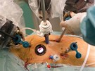 Operace srdce za pomoci robota - Jedno z ramen robota nese kameru, která v tle