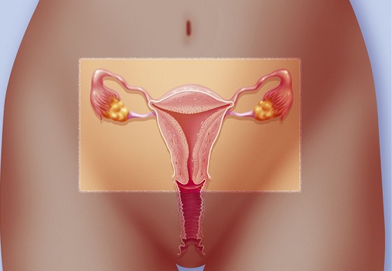 Odstranění dělohy může ženě zachránit život (ilustrační snímek)