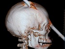 Tomografický sken hlavy tyiadvacetiletého dlníka z Brazílie, jemu hlavu