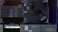 Snímky vyetované koky z poítaového tomografu