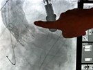 Kardiologická operace zúžené chlopně novou metodou ve Fakultní nemocnici v...