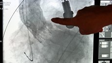 Kardiologická operace zúené chlopn novou metodou ve Fakultní nemocnici v Plzni. Na snímku zleva operatéi kardiolog Viktor Zlocha a intervenní kardiolog Jan Peek.