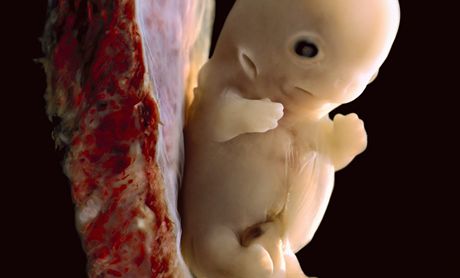 Irský zákon o potratech je zdaleka nejpísnjí v celé Evrop. Ilustraní snímek potraceného plodu.