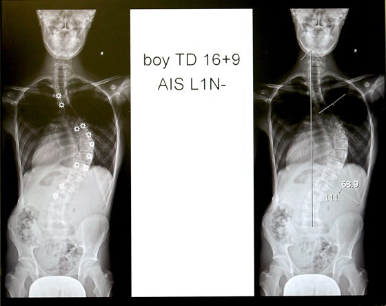 Lékai z Fakultní nemocnice Brno operují dtskou skoliózu pátee pevratn...