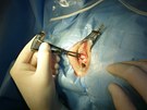 Chirurg pemuje o kolik milimetr posune (zkrátí) okohybný sval.